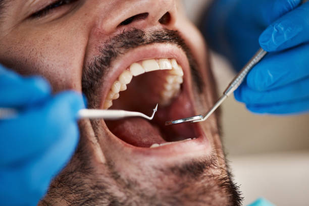 Best Emergency Root Canal Treatment in Blue Ridge, VA